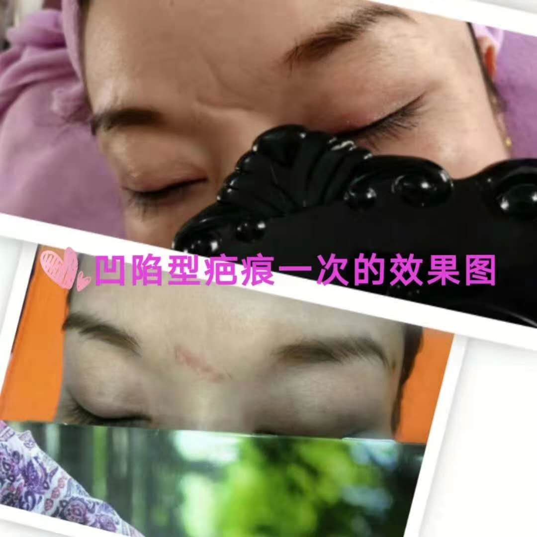 从自行车上摔下磕伤,处理后局部组织塌陷,留下两道明显的凹陷疤痕,想