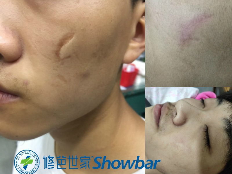 凹陷疤痕变平复从质疑到眉开眼笑