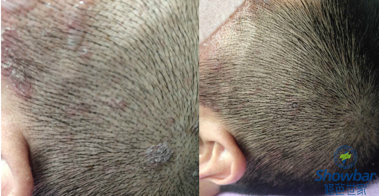 祛除痛痒溃烂斑块,不再被喊"疤瘌头"